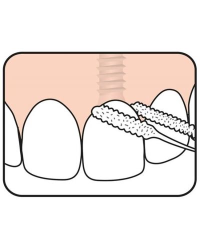 Tepe Конец за зъби Bridge & Implant, 30 броя - 2