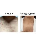 Dr. Tisha AC7 Анти-акне серум с микроигли, 3 x 1 g - 3t