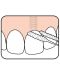 Tepe Конец за зъби Bridge & Implant, 30 броя - 2t